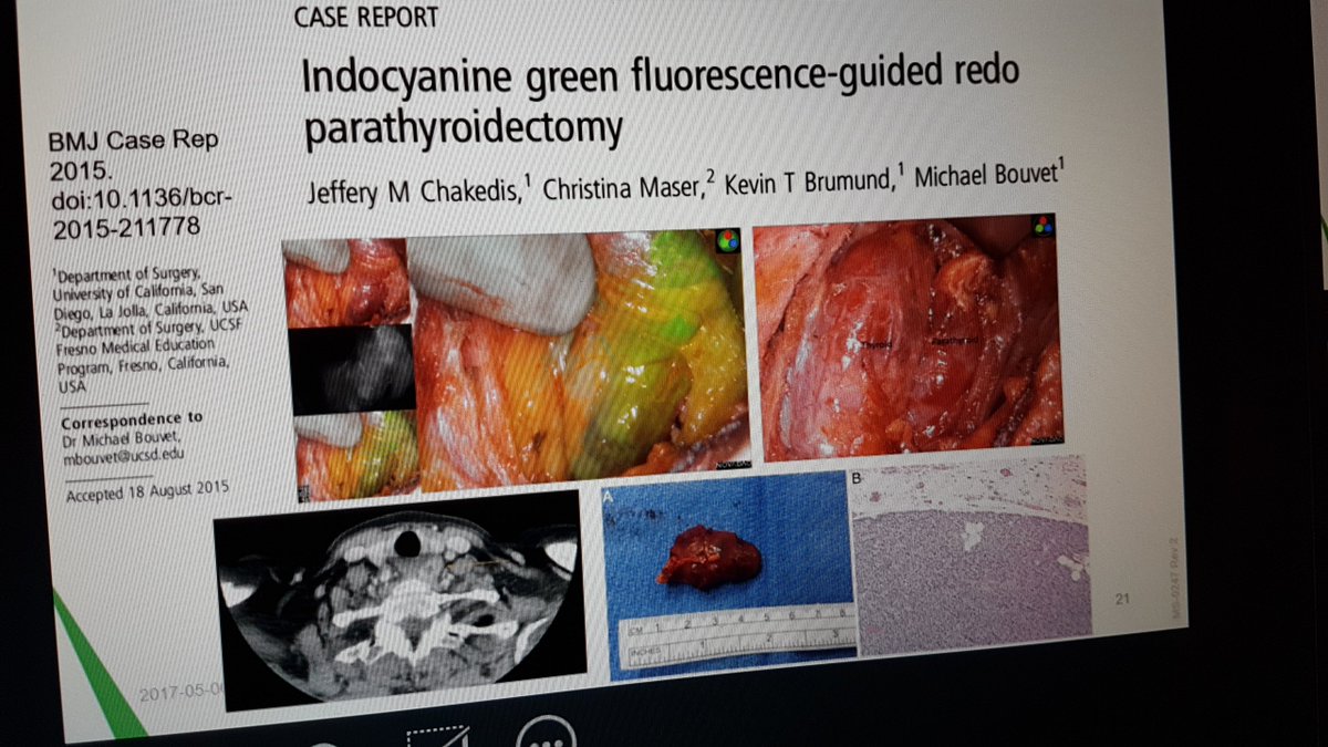 StrykerBreast's tweet image. Dr. Bouvet says the use of fluorescence imaging and ICG helps intraoperative decision making in parathyroid surgery #iSPIES @MichaelBouvet