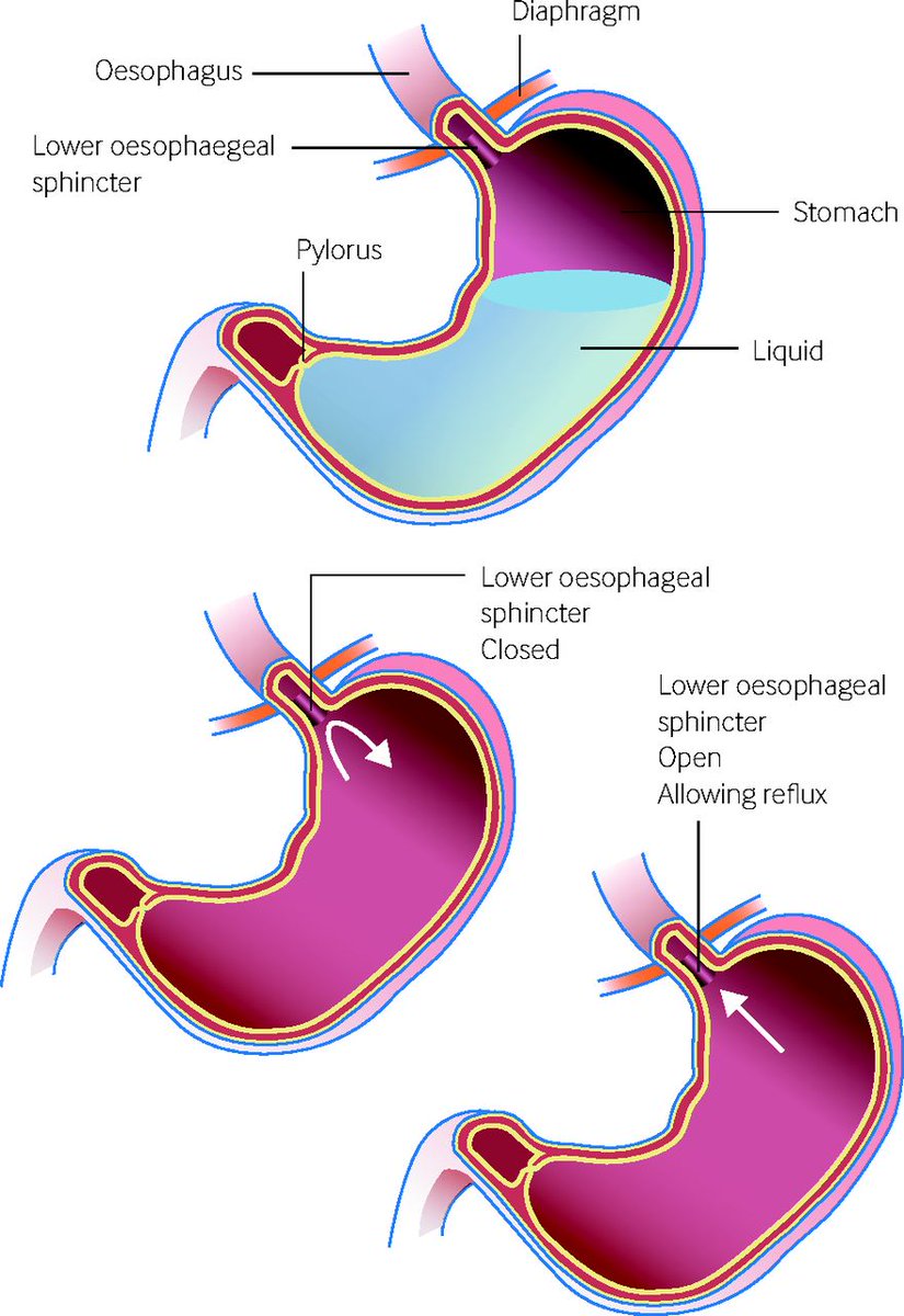 Mechanism of gastro-oesophageal reflux. Read the #BMJPractice article on ongoing vomiting in an infant bmj.com/content/357/bm…