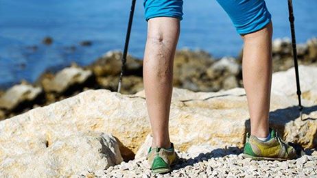 DrMajedChane's tweet photo. You may consider #varicosevein treatment if you feel veins look unsightly; if leg swelling or skin changes develop over prominent veins https://t.co/TqS9sPyknx