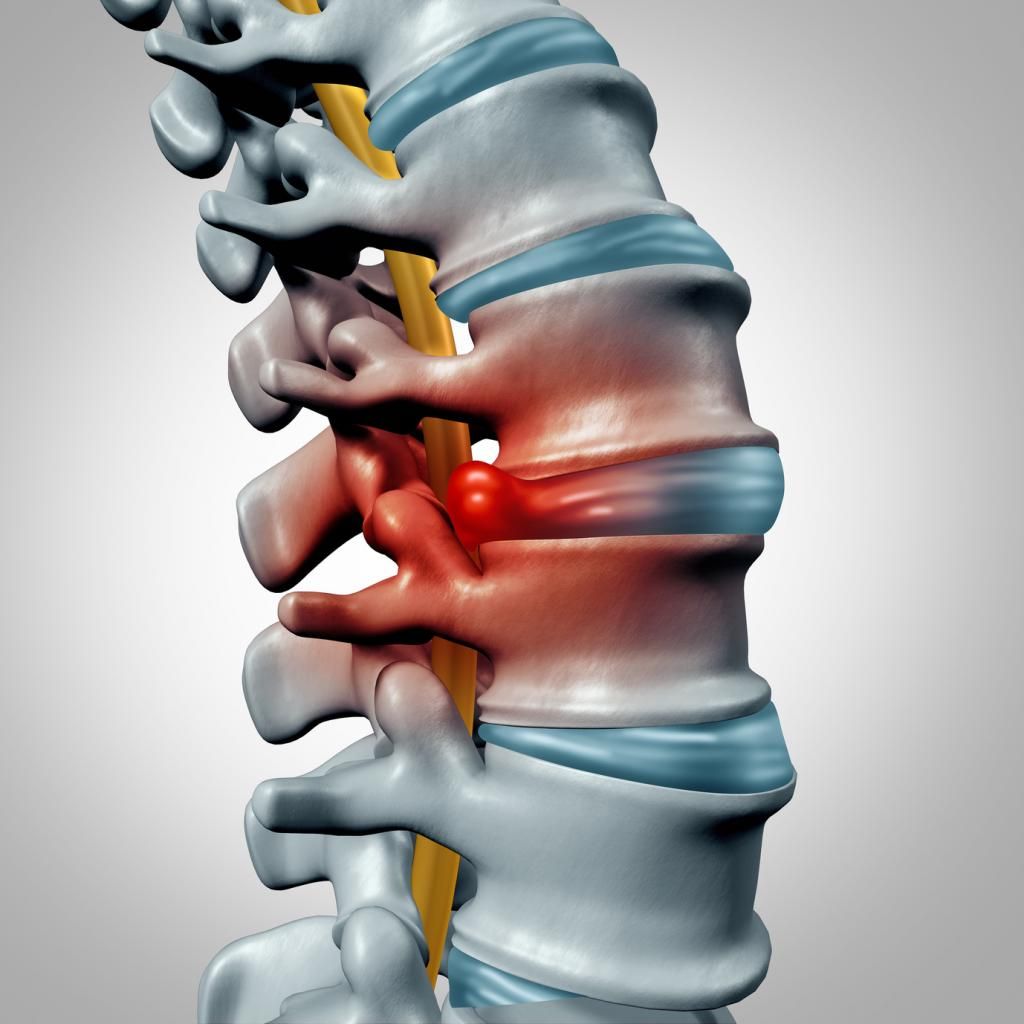 PriorityChef's tweet photo. Best Exercises To Rehab A Bulging Disc Injury #backpain #bulgedisc #exerciseforbackpain https://t.co/fwPVNC28G6 https://t.co/e7NbHzUCVO