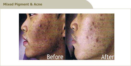 angelsmith1987's tweet photo. Acne Scar Treatment in Malaysia - Dermlaze !!!
Read Tips Here: https://t.co/5tQ17wwWog
#Dermlaze
#AcneScarTreatment
#Malaysia https://t.co/NSmbYahLFg