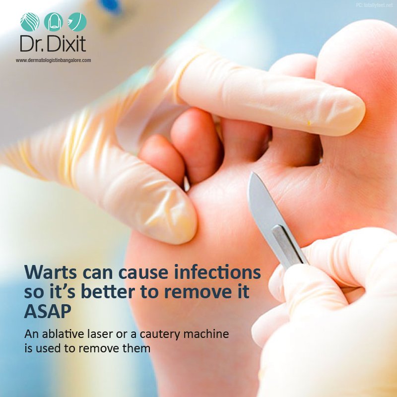 DermaBlore's tweet photo. Book online appointment with Dr Rasya Dixit here - https://t.co/VIFsTY4ysc 
#Warts #Ablativelaser #lasertreatment #skincare https://t.co/kbi1CViw1d