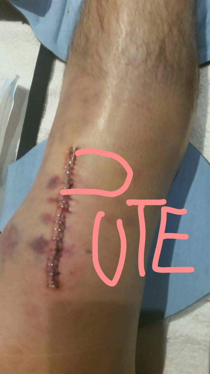tomlabouij's tweet photo. J'y rpense mais jme suis grave fait chier après mon opération ou alors leurs médocs sont NRV @pierro21250 @Alxncash https://t.co/l0N7pNNXMS