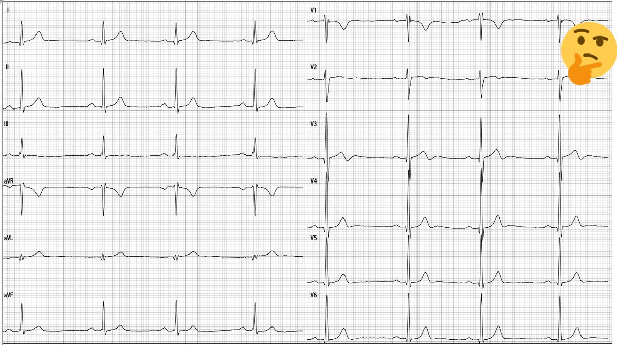 atypicalflutter's tweet image. Asymptomatic Male 38, athletic body, no family SCD. EKG2016 😒EKG2017😱. EF good. Any Thoughts?