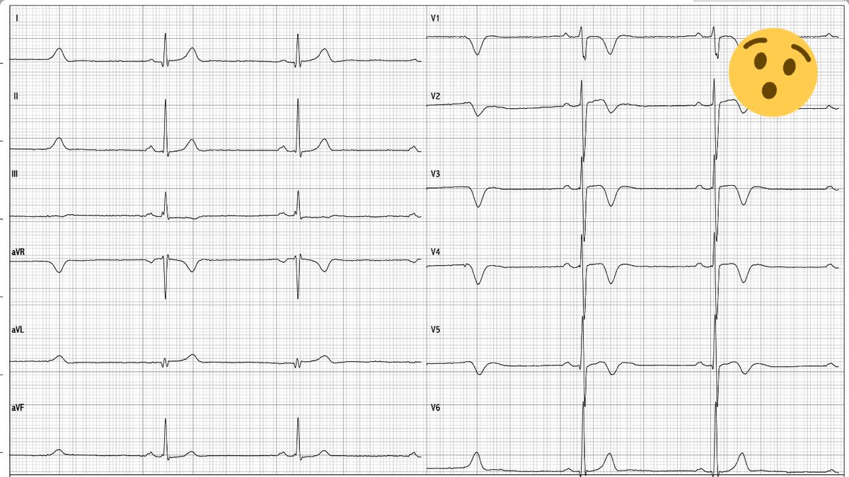 atypicalflutter's tweet image. Asymptomatic Male 38, athletic body, no family SCD. EKG2016 😒EKG2017😱. EF good. Any Thoughts?