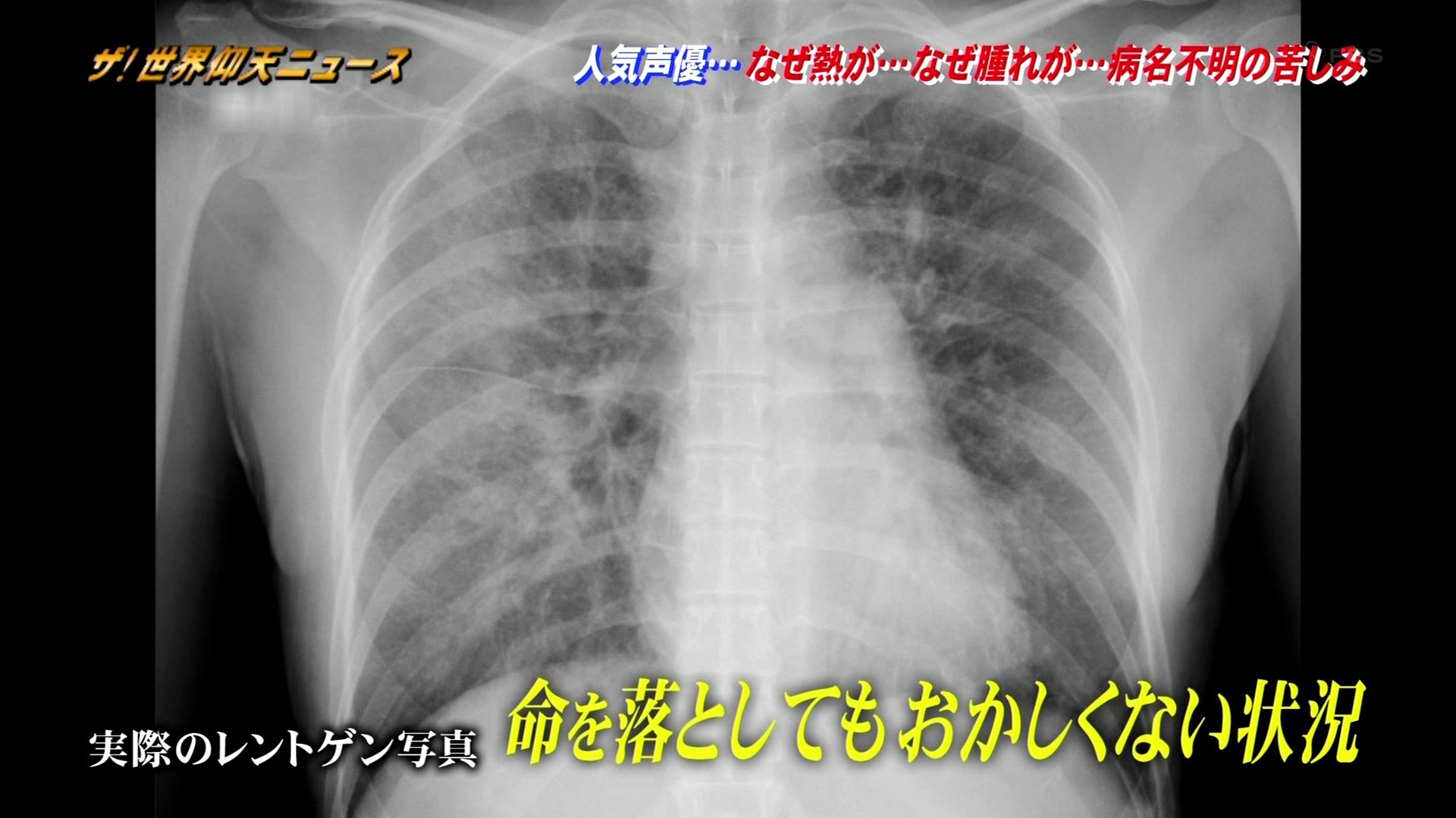 Tka24 Ar Twitter レントゲンで肺が真っ白になるほどの肺炎を起こしていた 世界仰天ニュース 仰天ニュース Tka24 Ar Twitter レントゲンで肺が真っ白になるほどの肺炎を起こしていた 世界仰天ニュース 仰天ニュース