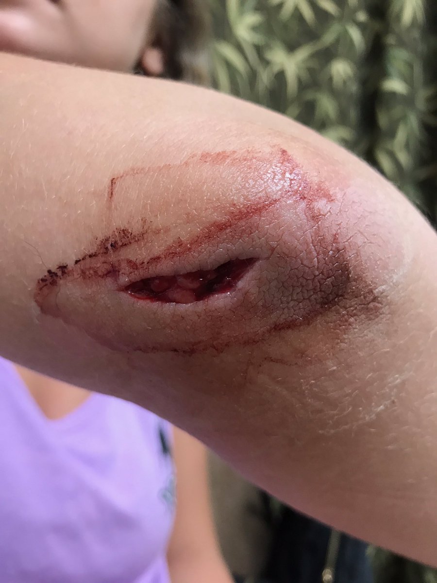 morgandebo's tweet photo. :) my elbow :) https://t.co/ANhXisXAN6