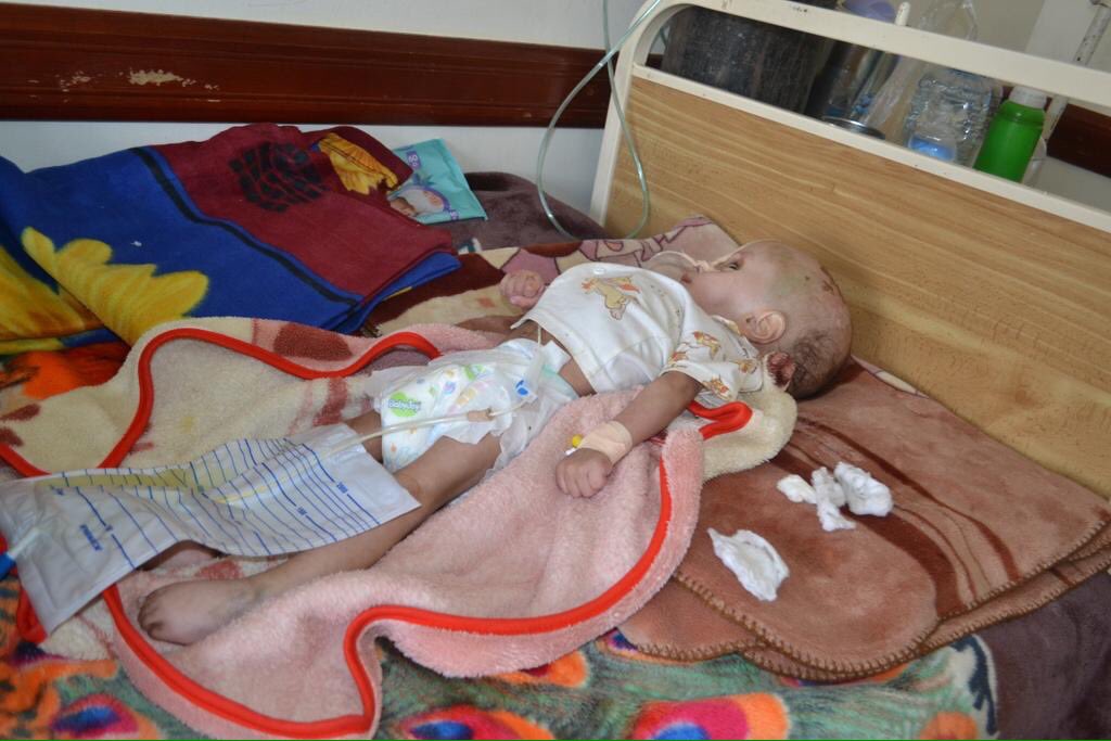 Yaman negara miskin. Diserang Arab Saudi sejak Mac 2015. Kini alami bencana kemanusiaan.

Mati: 8,010
Cedera: 44,538
(Setakat 14 April 2017)