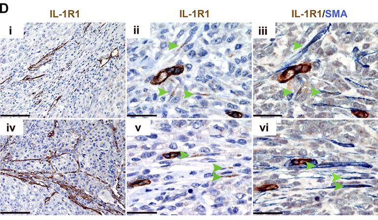 JExpMed's tweet photo. In tumors from patients on treatment, signaling from inflammatory niches is amplified in presence of MAPK inhibitors https://t.co/9drKnjtA0v https://t.co/kpTbEagU8a