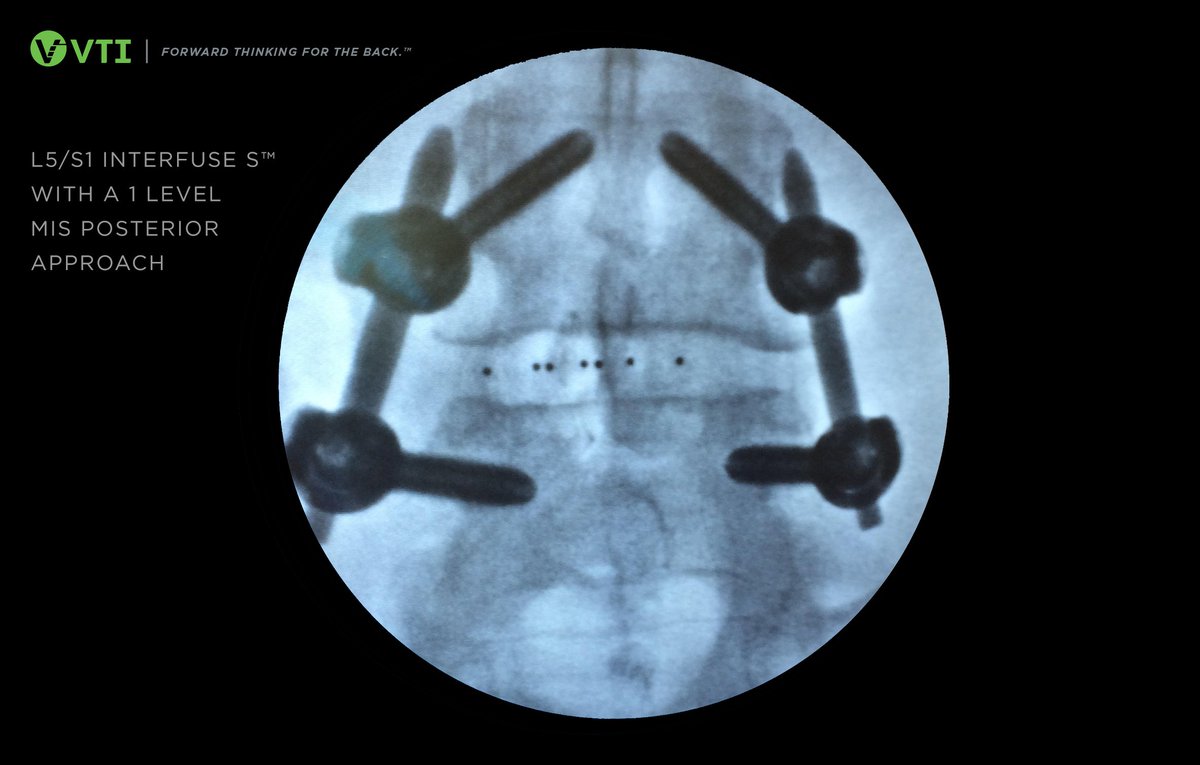 vtispine's tweet photo. Posterior approach with a large footprint? Yes, it's possible! See how here: https://t.co/3Thz8Vn7Mu #spinefusion #mis #spine https://t.co/UbV4LltKSD