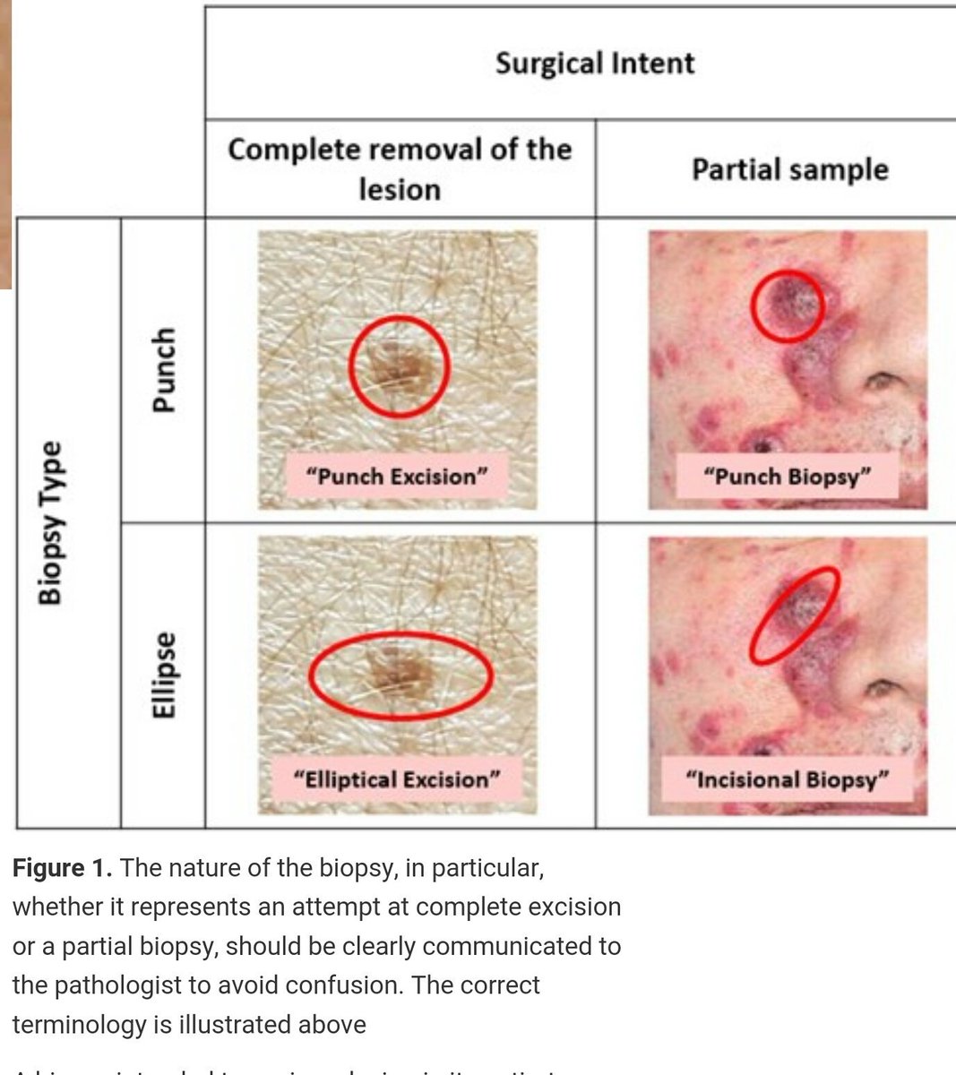 Benjamin Wood (@benjaminawood) on Twitter photo Communicate surgical intent when sending a skin bx! Great illustration by <a href="/nathan_t_harvey/">Nathan Harvey</a> racgp.org.au/afp/2017/may/s… #pathology #dermatology Communicate surgical intent when sending a skin bx! Great illustration by <a href="/nathan_t_harvey/">Nathan Harvey</a> racgp.org.au/afp/2017/may/s… #pathology #dermatology