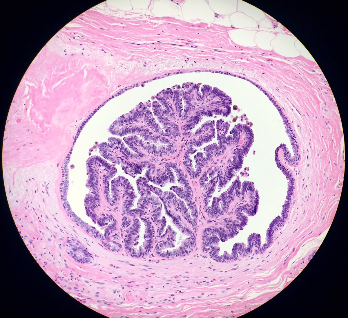 LizaMQuintana's tweet photo. It's the small things that make me smile after a long day at work... like this tiny papilloma ☺️🌳🔬#breastpath https://t.co/NpoGX7DeMG