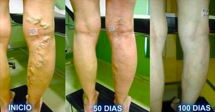 RAMONAMARTINE12's tweet photo. Disminuye tus varices con una mezcla de Áloe vera, zanahoria y vinagre de... https://t.co/oEZfbhHeI4 by #Salud24Info via @c0nvey https://t.co/jPyVuonFeO
