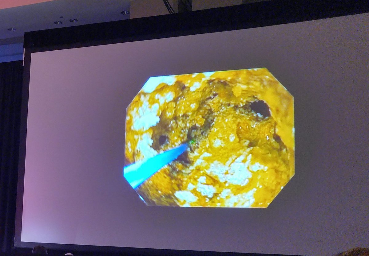 ASGEendoscopy's tweet image. Dr. Ramón Sánchez Ocaña from Spain presents on Combined Laser and Hydrostatic Balloon Lithotripsy at the ASGE #WorldCup at #DDW17.