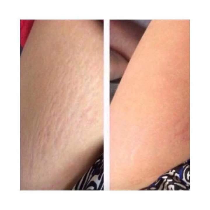 PerfectYOU23's tweet image. Anyone suffer with stretchmarks ? 
look at this !!! 👇👇👇👇
Message or comment for more info