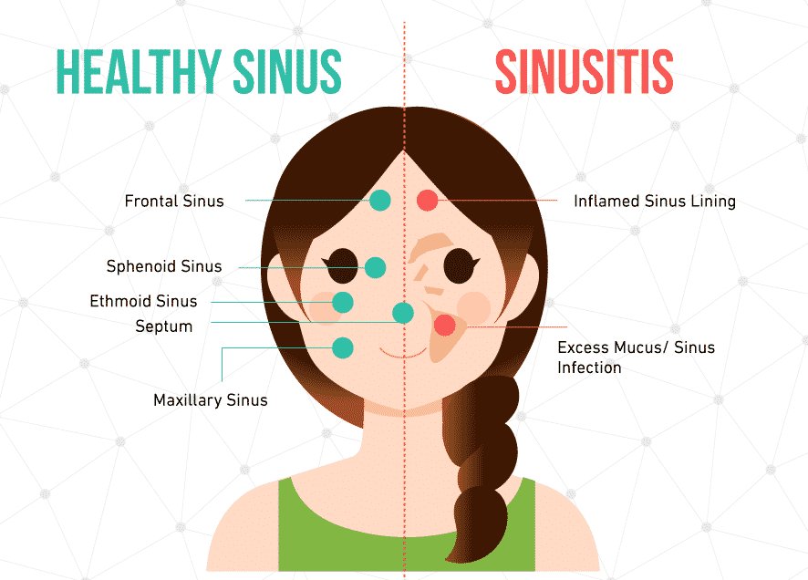 Sinuwave's tweet photo. Sniff, slice or swallow? All guesses are good when it comes to chronic #sinusitis https://t.co/BHWuRwLlMs #SinusHelp https://t.co/CBGW53TFRA