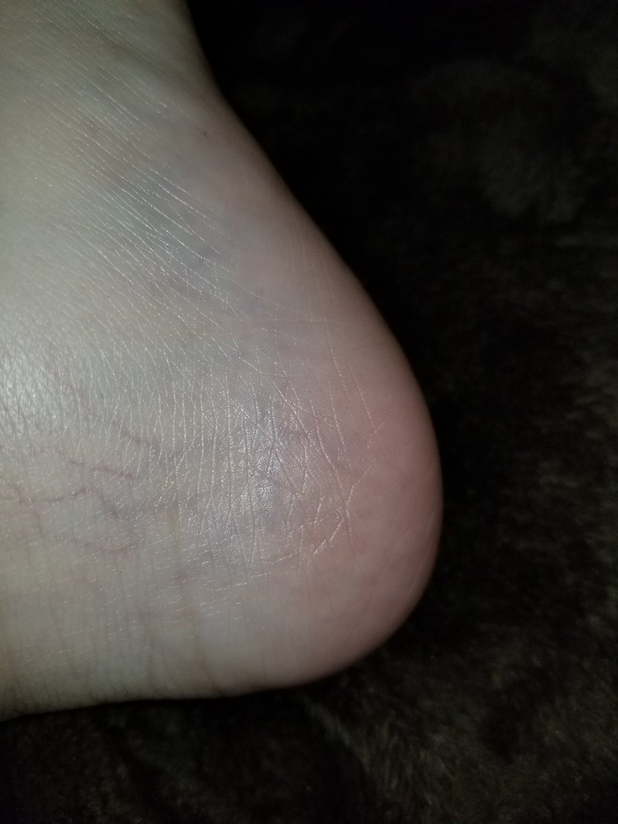 pammycoolz's tweet photo. @InfluensterVox @Ilove7thHeaven Look at the results!!!! I have really dry heels!!!! #PoppyVoxBox #contest https://t.co/GnClBVn4OE