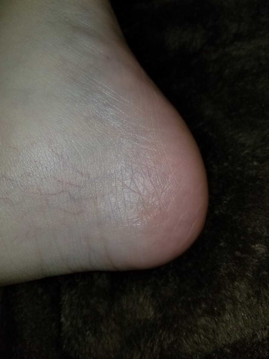 pammycoolz's tweet photo. @InfluensterVox @Ilove7thHeaven Results!!!! No dry heels!!! #PoppyVoxBox #contest https://t.co/A6YX5gDjDy