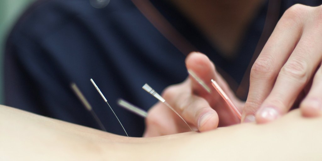 ACSMNews's tweet photo. Dry needling can be a promising option for athletes who are aiming to improve muscular flexibility &amp; muscular force. https://t.co/O4cvveQKn6 https://t.co/AMveymWiGN