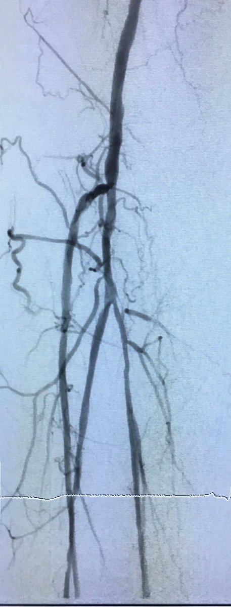 SOBE_Vascular's tweet photo. 51 yo M DM, foot abscess, CLI R6 #CSI #Chocolate #Lutonix #inlineflow #stopthechop @SDhandMD @kmadass @Mustapja @LessneVIR @JVIRmedia https://t.co/vtTbAFYsvq