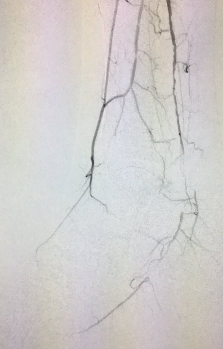 SOBE_Vascular's tweet photo. 51 yo M DM, foot abscess, CLI R6 #CSI #Chocolate #Lutonix #inlineflow #stopthechop @SDhandMD @kmadass @Mustapja @LessneVIR @JVIRmedia https://t.co/vtTbAFYsvq