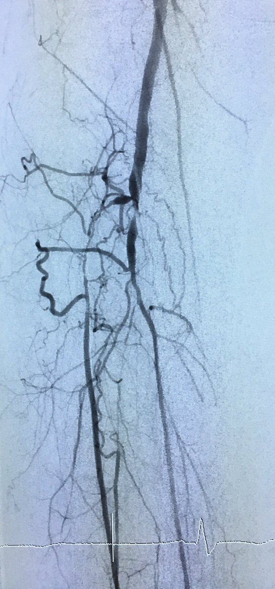SOBE_Vascular's tweet photo. 51 yo M DM, foot abscess, CLI R6 #CSI #Chocolate #Lutonix #inlineflow #stopthechop @SDhandMD @kmadass @Mustapja @LessneVIR @JVIRmedia https://t.co/vtTbAFYsvq