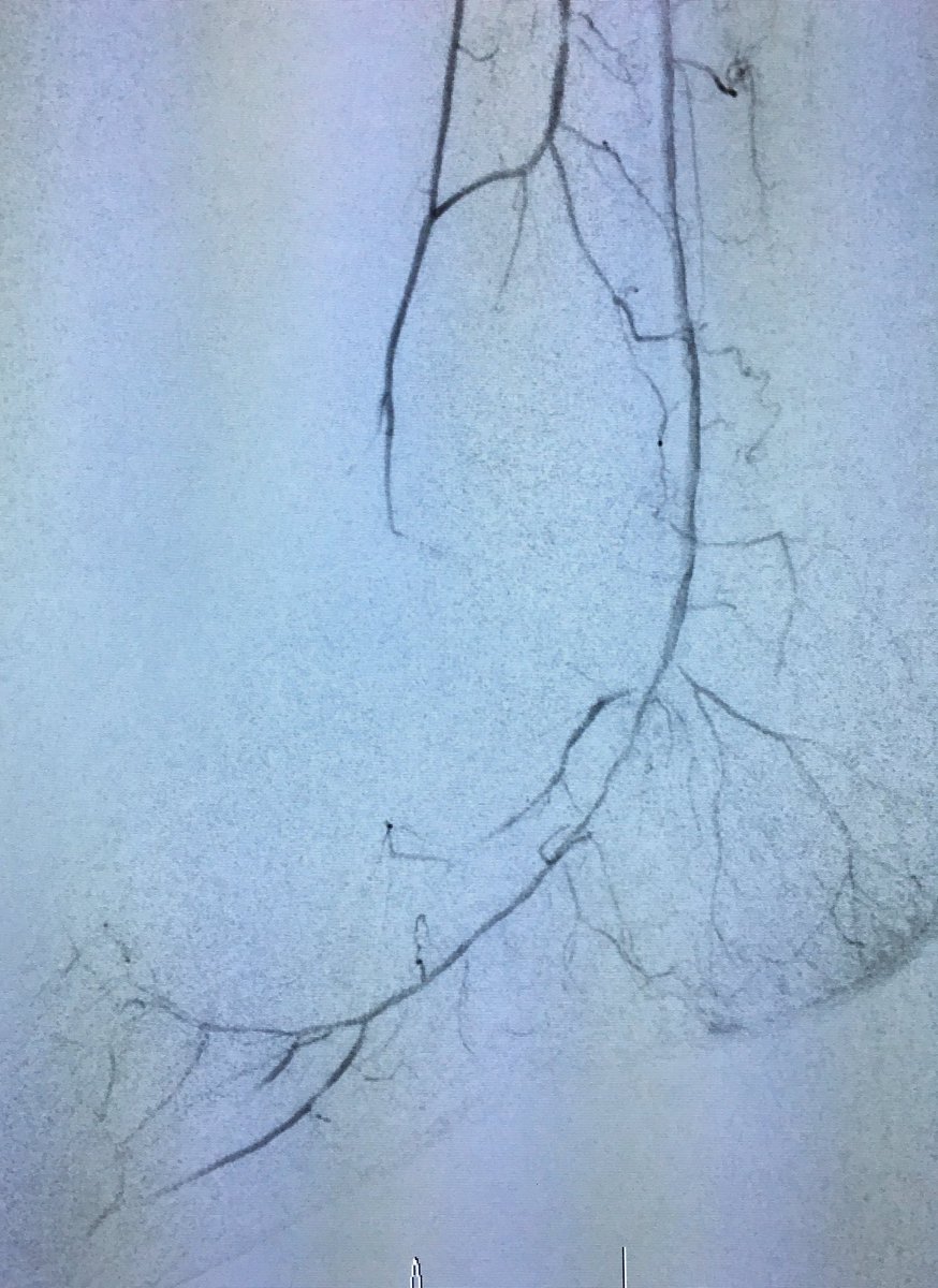 SOBE_Vascular's tweet photo. 51 yo M DM, foot abscess, CLI R6 #CSI #Chocolate #Lutonix #inlineflow #stopthechop @SDhandMD @kmadass @Mustapja @LessneVIR @JVIRmedia https://t.co/vtTbAFYsvq
