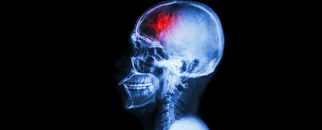Researchers Find #Gut #Bacteria Can Trigger Brain Lesions That Lead to #Strokes 
#Health
sciencealert.com/researchers-fi…