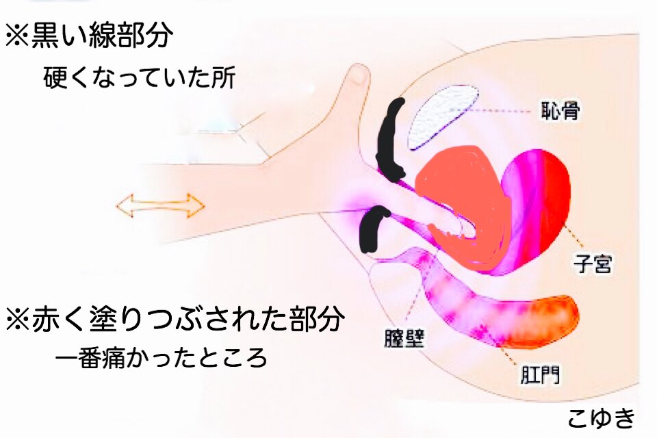 性 腟炎 萎縮 閉経後の萎縮性腟炎：症状、治療および原因