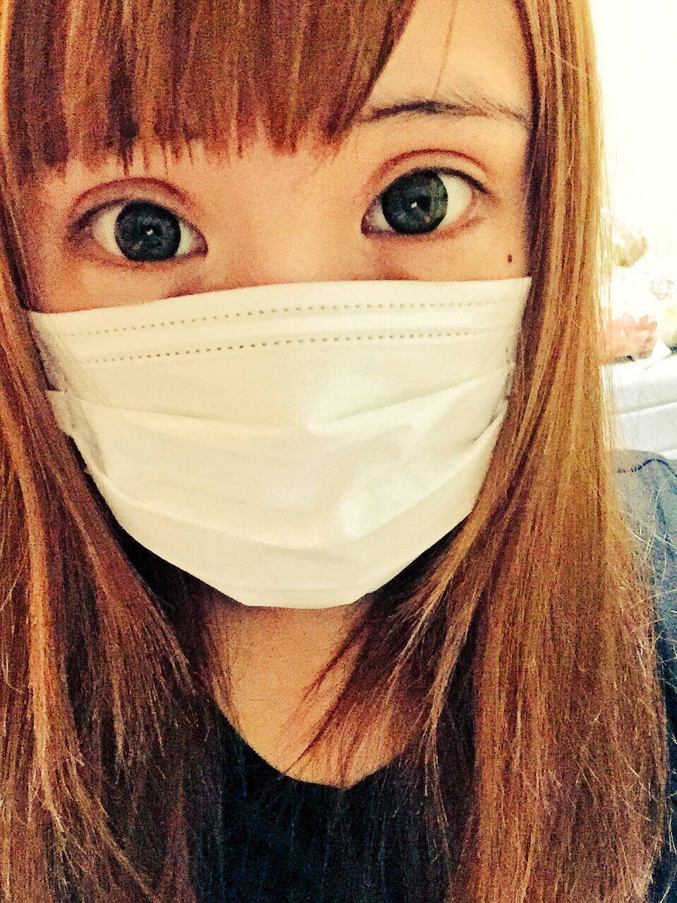 ð整形男子アレン様（旧）ð on Twitter: "僕の行きつけのシンシアクリニックで #アレン信者 様 ððが 幅広型の #二重全切開 と