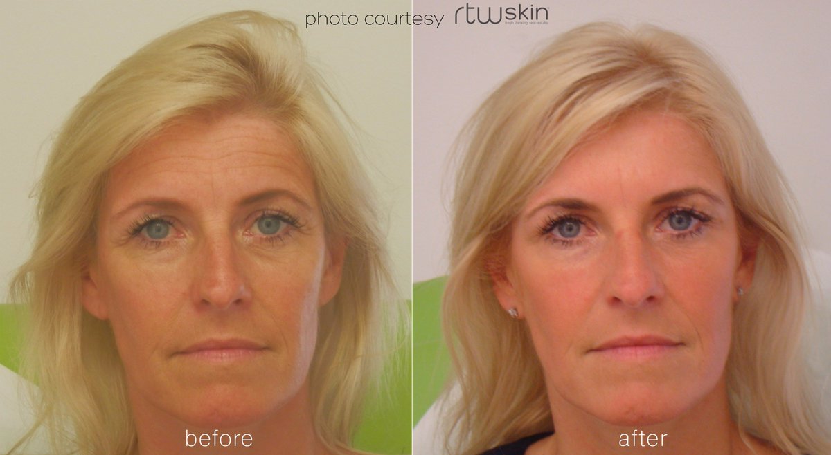 rtwskin's tweet photo. Another transformation of one of our beautiful clients
You can see here the result of #antiwrinkleinjections giving her a more #youthfulglow https://t.co/jo9jcdi8TR