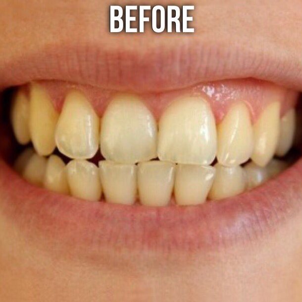 TonyaSm1's tweet photo. BEFORE &amp; AFTER only ONE use!!

I got my charcoal whitener from
 https://t.co/JMxNwGDXT9   💫 by #SportsVlness via @c0nvey https://t.co/rGrhcQFz19