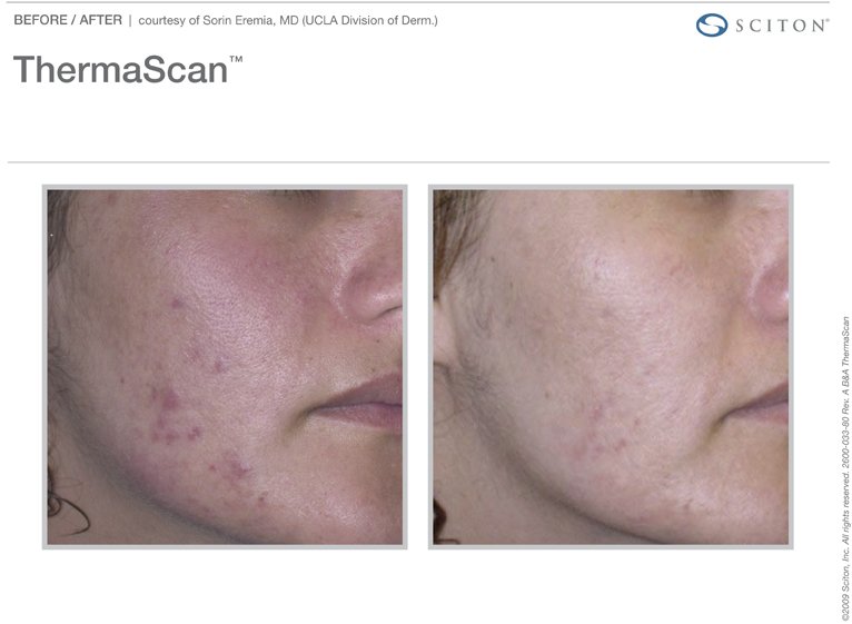 PinnacleMedSpa's tweet photo. Our aesthetician uses a light based acne treatments to solve the problem painlessly and effectively. #AcneTreatment https://t.co/l4acJvXdHs https://t.co/afCOlY5lMj
