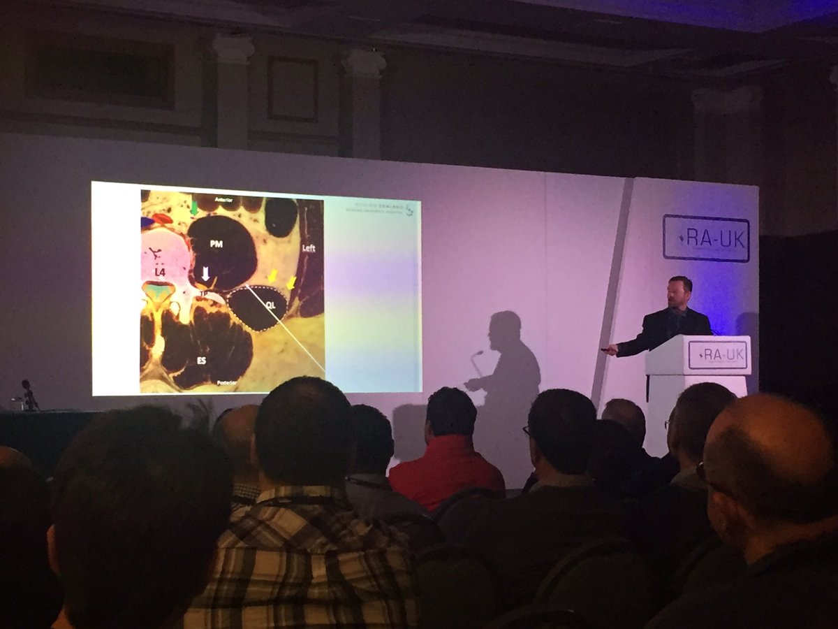 #RAUK17 <a href="/RegionalAnaesUK/">RA-UK</a> Jens disclosing the elusive anatomy of the QL. TQL- T6-L1- 36 hrs visceral analgesia with Dxmet (a2)200mcg.