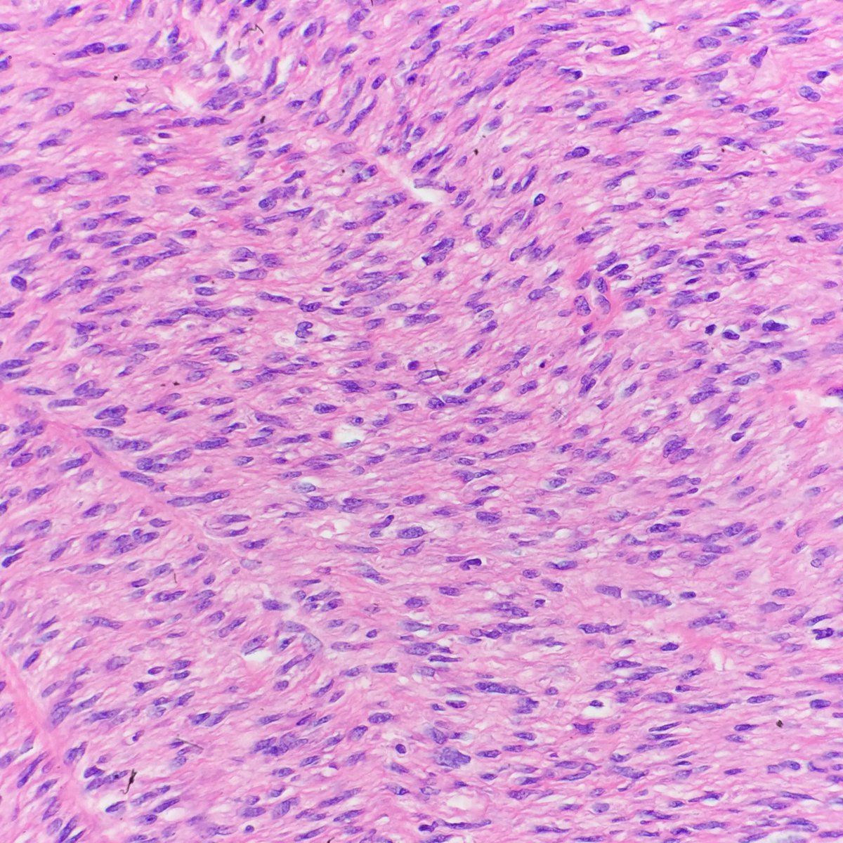 Michael Feely Do On Twitter Incredibly Infiltrative Yet Non Destructive Classic Congenital Mesoblastic Nephroma Pedipath Gupath