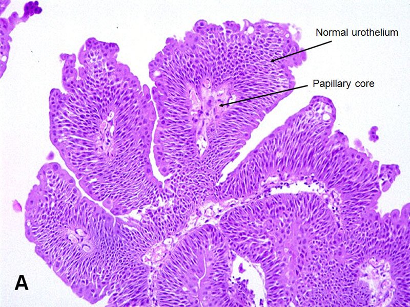 papilloma urinary bladder histopathology)
