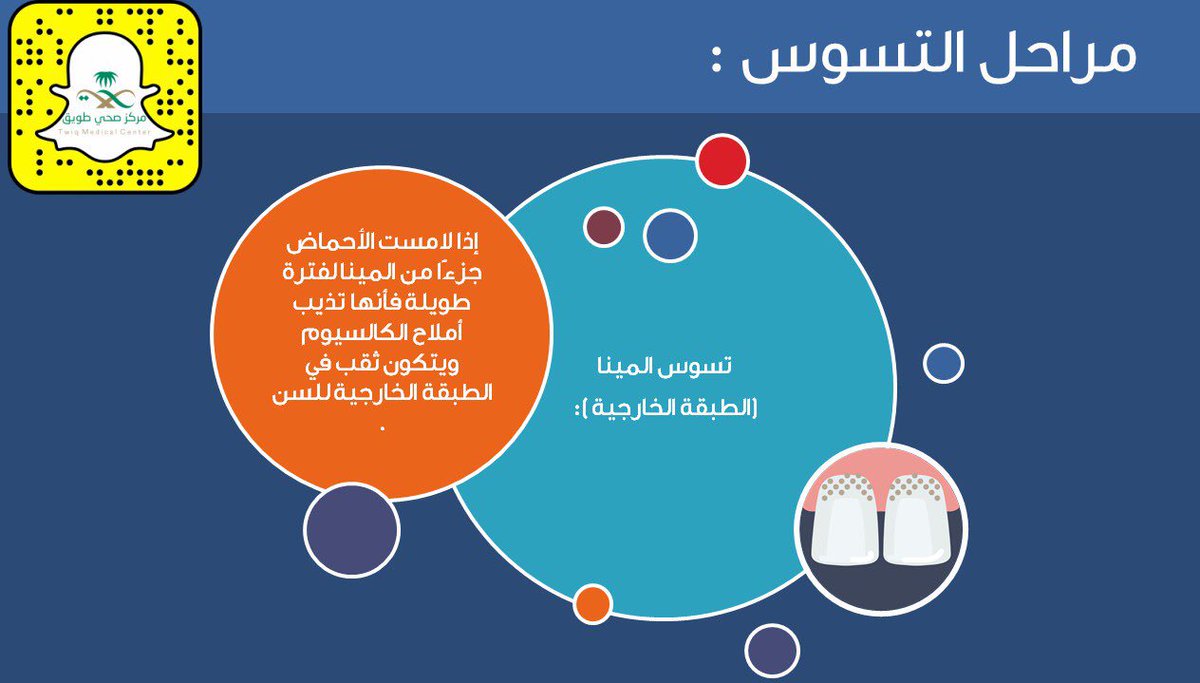 twiq2030's tweet photo. .@tfrabiah #تثقيف_صحي مراحل تسوس الأسنان
#مركز_صحي_طويق
#إدارة_طب_الأسنان
#صحة_الرياض
#وزارة_الصحة
@tfrabiah https://t.co/hLMle2MaaC