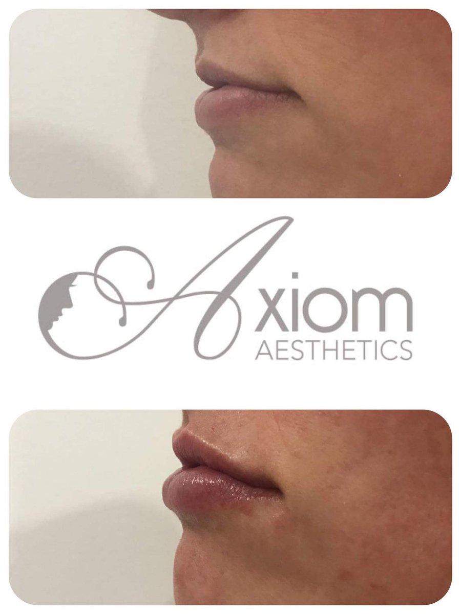 aestheticsaxiom's tweet photo. Increase in volume &amp; a more defined look #juvederm #lipfillersessex #juvedermlips #essexaesthetics taking appointments for Friday 19th May https://t.co/WBLl37X0n1
