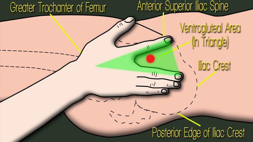 Ventrogluteal Bölgeye Enjeksiyon Uygulama kadinvehastaliklari.com/ventrogluteal-…