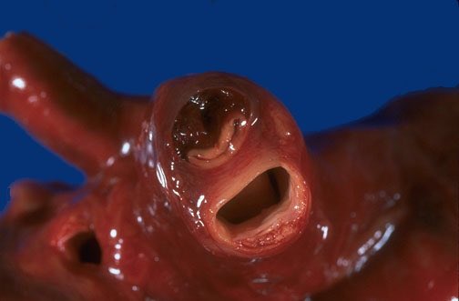 60SecMedEd's tweet photo. Aortic dissection leading to carotid artery dissection/compression + stroke symptoms https://t.co/jdLKz4NWJp
