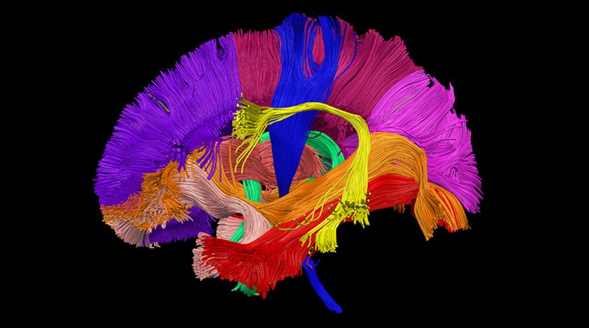 Spectrum's tweet photo. New results from #IMFAR could be used as a benchmark to investigate how brain development is altered in #autism. https://t.co/OcIbOpEBQa https://t.co/drNQ45u4OS