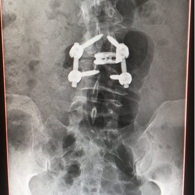 bionicpiggy's tweet image. #NewProfilePic #MyNewBack 😊#spinalsurgery #longroadtogo #recovery #bionic #blessed
