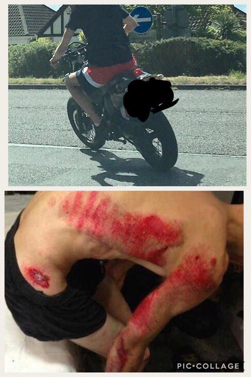 Summer is here. Don't be a 🤡
Dress for the slide not the ride 
Otherwise the top pic leads to the bottom injuries