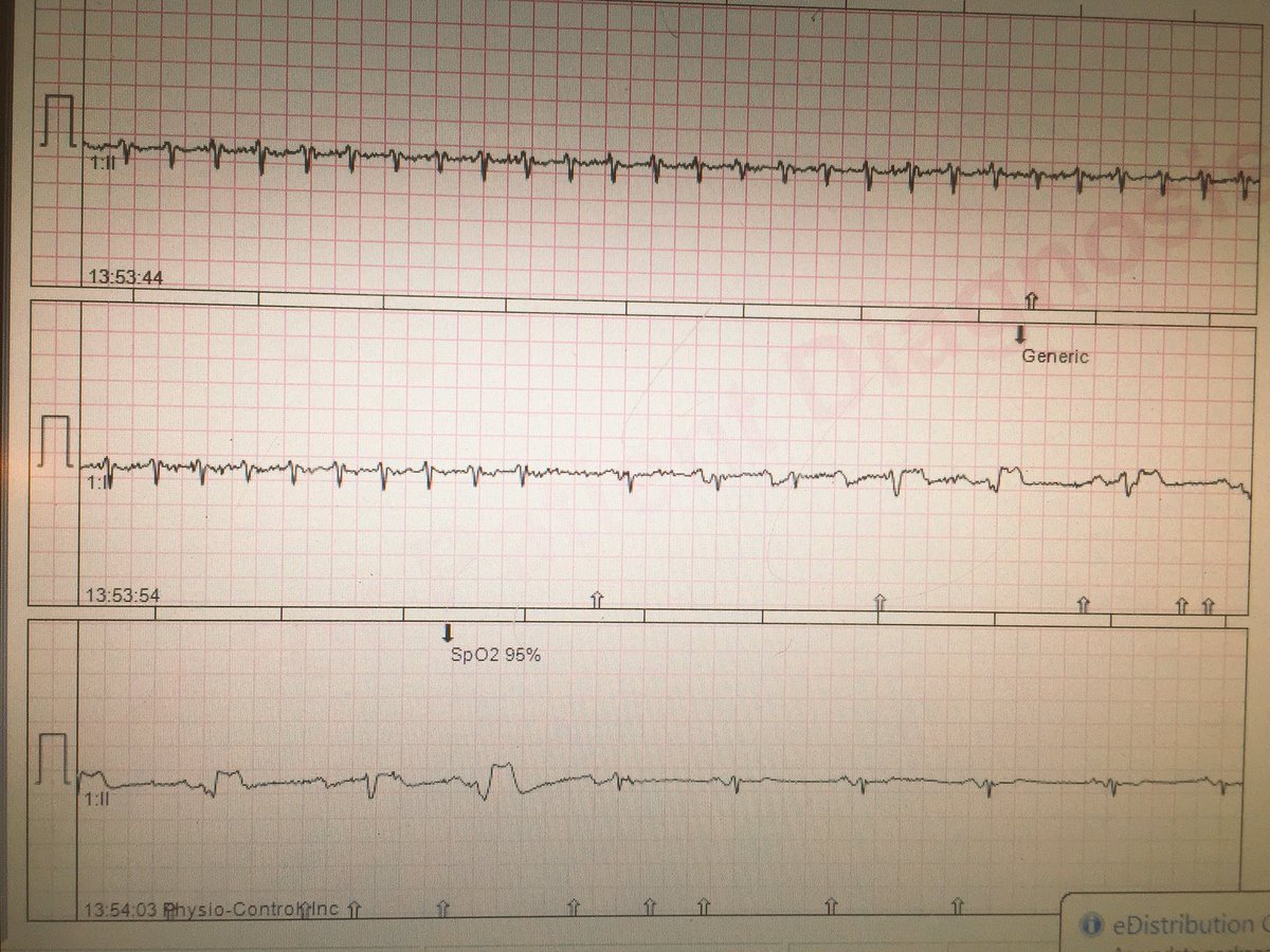 ThatVeganDoc's tweet image. I. Love. Adenosine. #JustEMSThings #Cardioversion #SVT