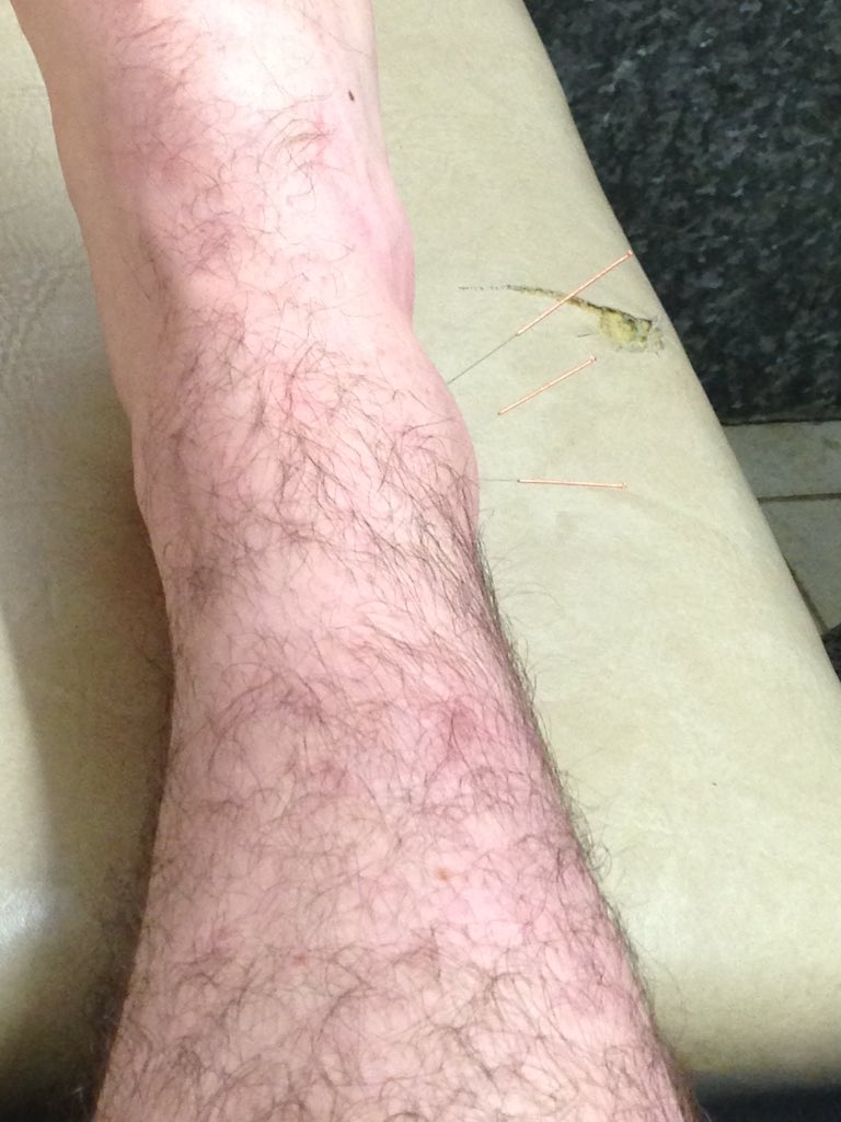 brad_evans_'s tweet photo. Can't wait till my ankle is better, Missing rugby a little! 💉🏉 https://t.co/n1ycw2GMwL