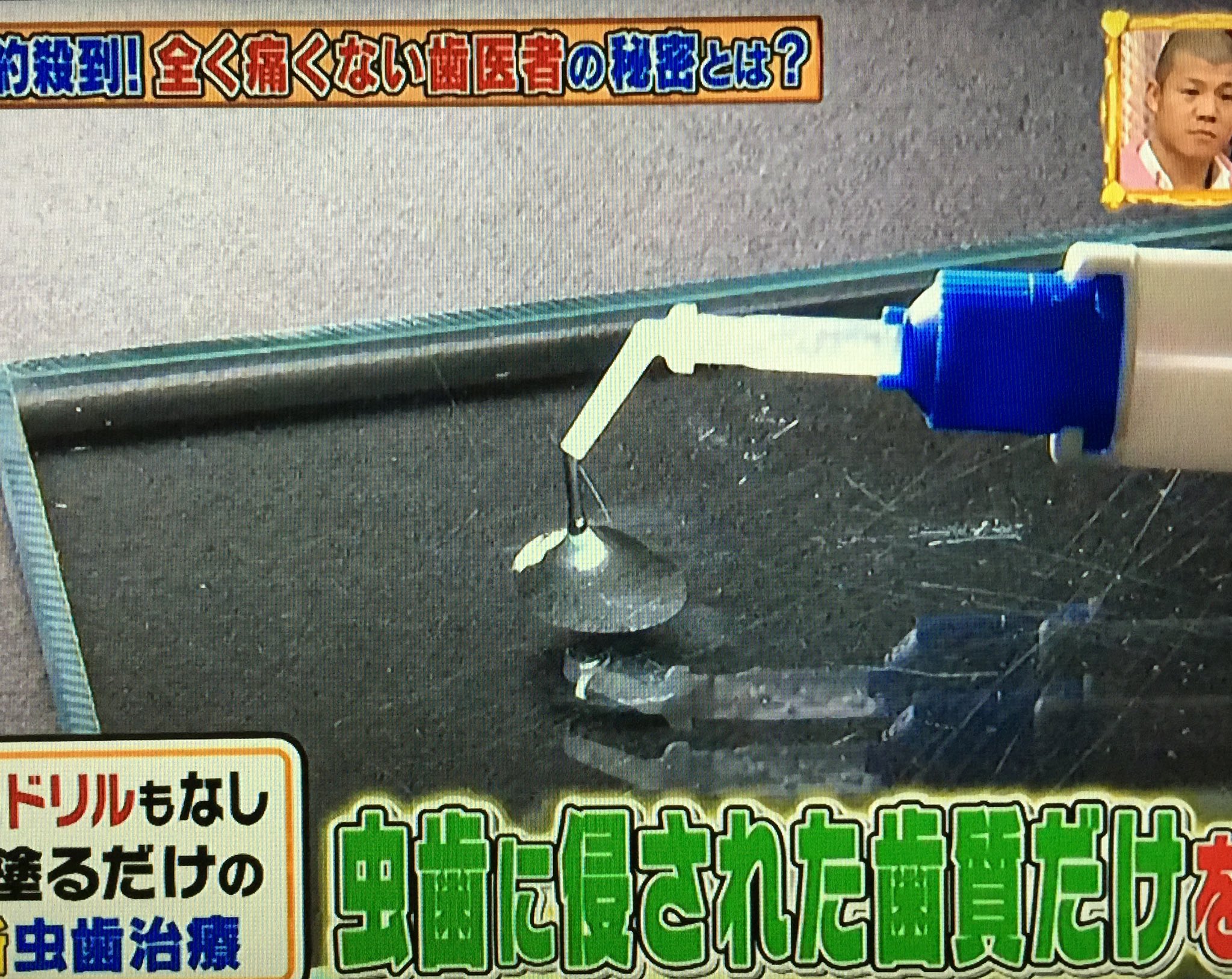 Twitter 上的 ろろ王国 テレビ 全く痛くない虫歯治療薬 カリソルブ 保険適用外で 虫歯1本につき1万円だが 1回の治療で済むらしいです カリソルブ 虫歯 T Co Iql7qurfpa Twitter