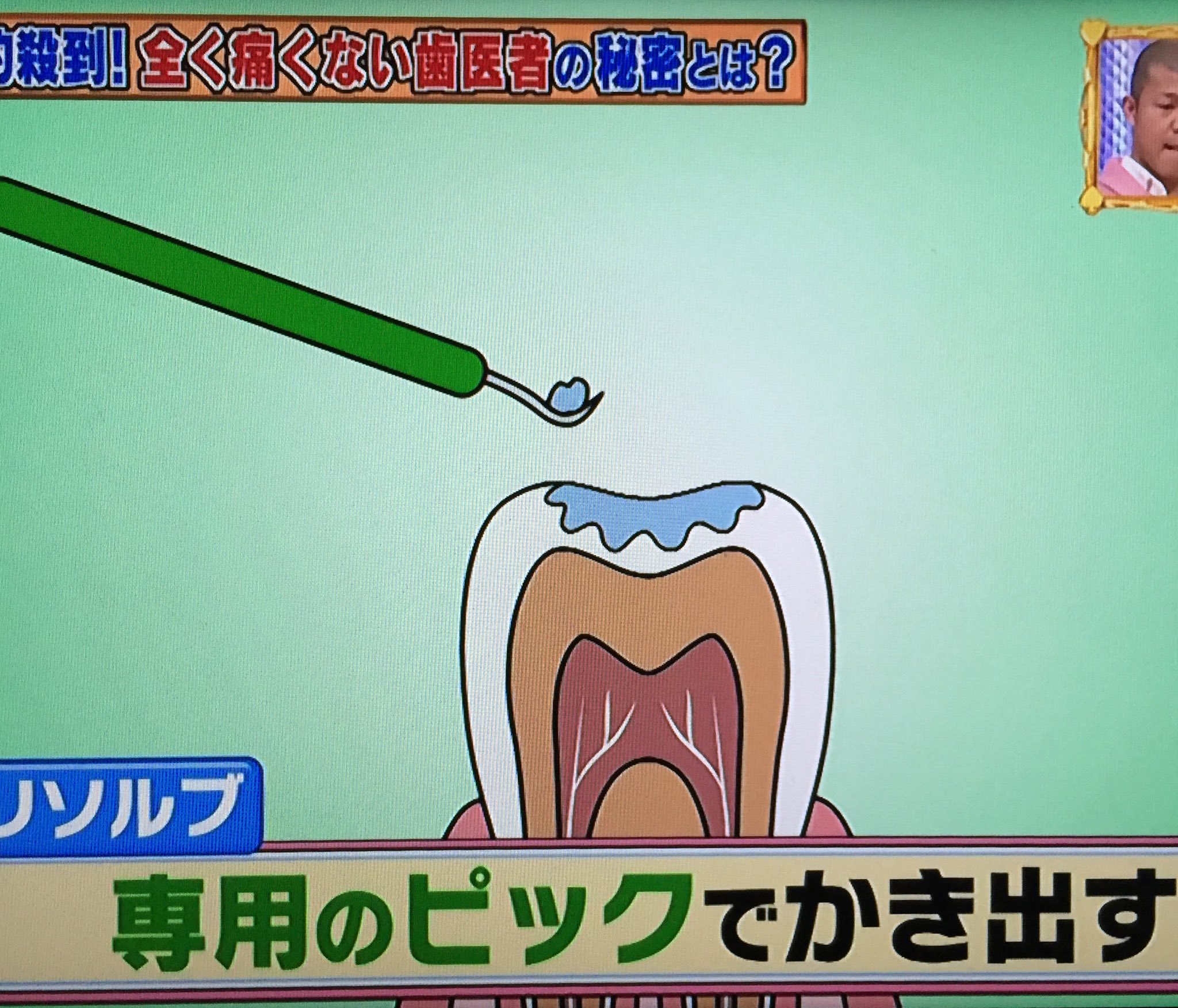 ろろ王国 テレビ 全く痛くない虫歯治療薬 カリソルブ 保険適用外で 虫歯1本につき1万円だが 1回の治療で済むらしいです カリソルブ 虫歯 T Co Iql7qurfpa Twitter