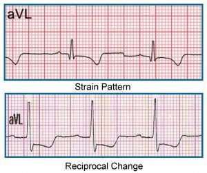 RewAU's tweet image. Not sure about that inferior STEMI ? Take a look at aVL .. foamlinks.com/2016/02/take-a…