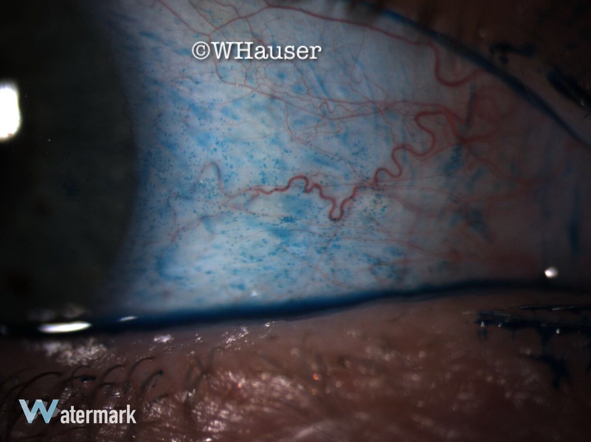 drwhauser's tweet photo. Using Lissamine Green? If not, you're missing OSD. #dryeye @Eyeppl @gordonbethwaite @HelpMyDryEyes @drbarnett1 https://t.co/36Se53CQUv