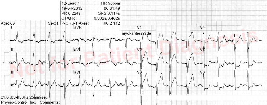 ECGoftheday's tweet photo. LVH or STEMI? @ECGoftheday @prehospECG #EMS #cardiology #ekg #ecg #Paramedic https://t.co/0f8CphV3Jy